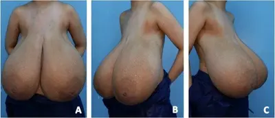 Macromastia cases (pictures) cover image