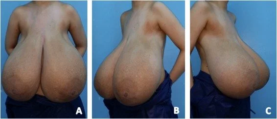 Macromastia cases (pictures) image 1