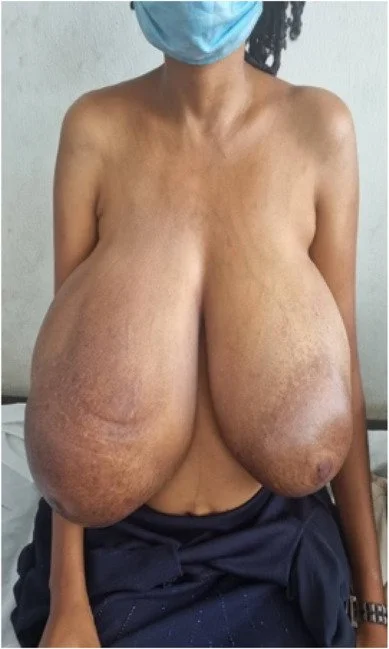 Macromastia cases (pictures) image 3