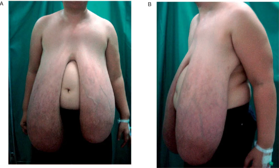 Macromastia cases (pictures) image 7