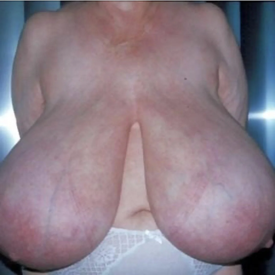 Macromastia cases (pictures) image 9