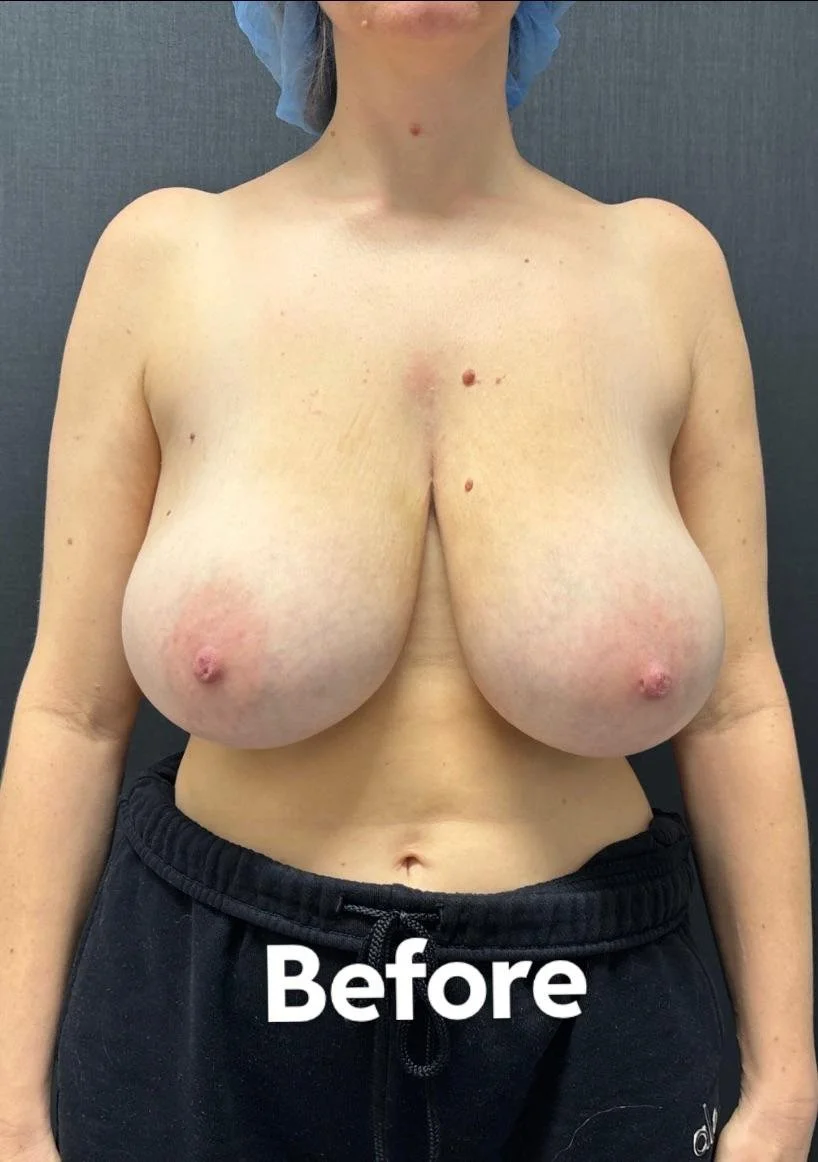 Huge Tits Before Reduction 6 image 19