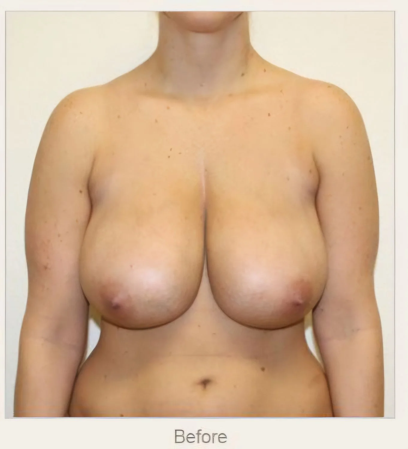 Huge Tits Before Reduction 6 image 2