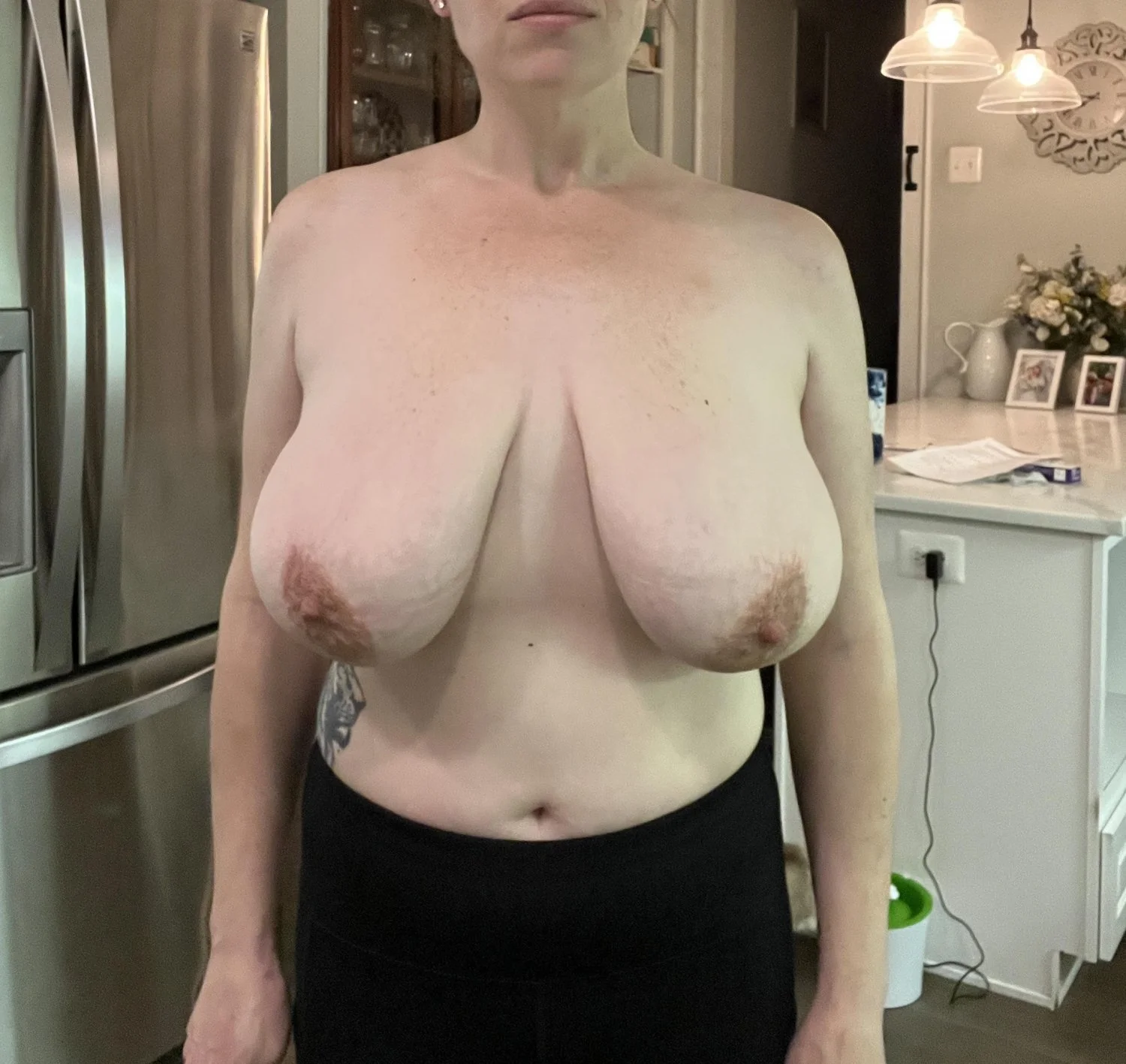 Huge Tits Before Reduction 6 image 23