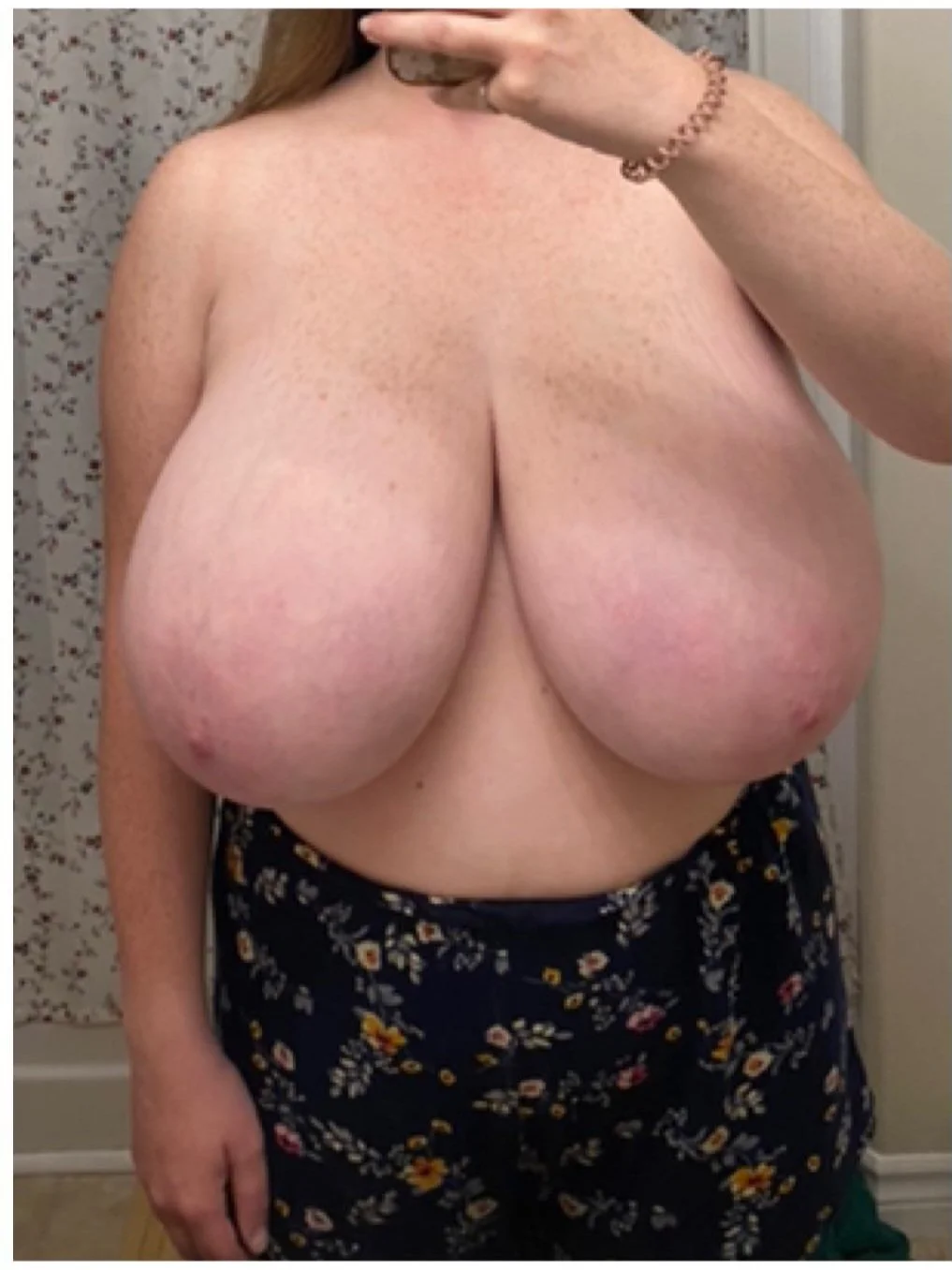 Huge Tits Before Reduction 6 image 27