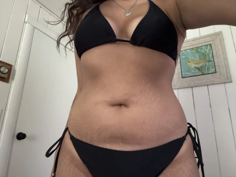 Kylie's Gross Stretch Marks image 9
