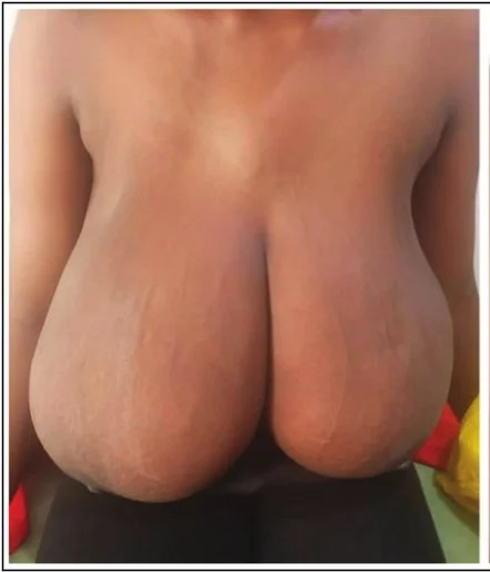 Huge Tits Before Reduction 7 image 36