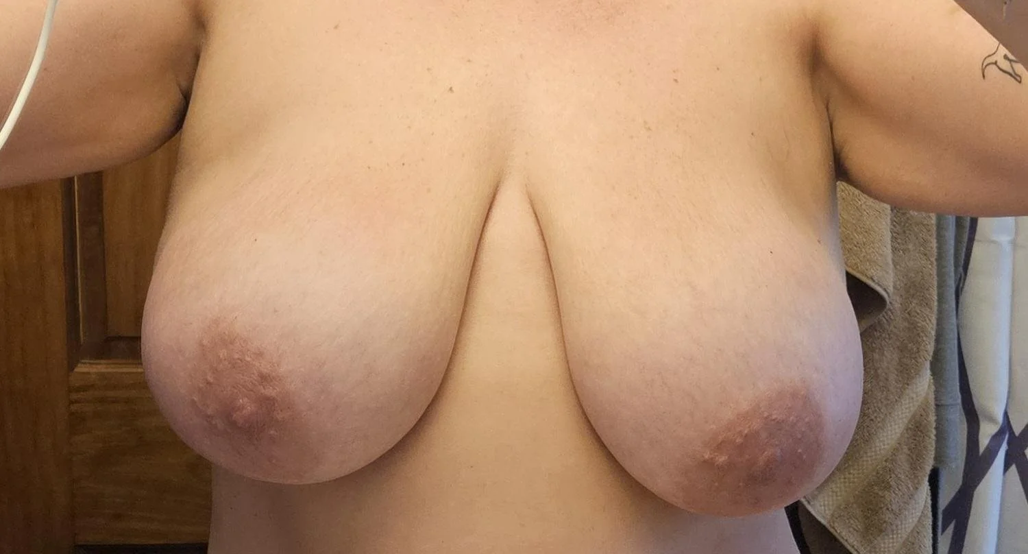 Huge Tits Before Reduction 7 image 6